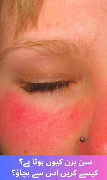 Why does sunburn happen? How to prevent it?